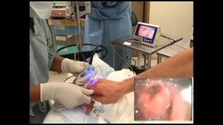 GlideScope Pediatric Airway Rounds Case Study 2 month old Inguinal Hernia Repair [upl. by Helmut]