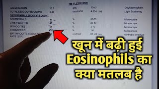 Eosinophils high in blood test means eosinophilia High Eosinophils cbc Blood test in hindi [upl. by Eladnek]