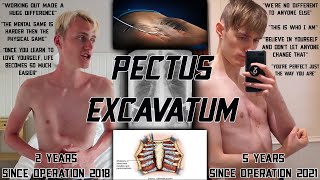 5 Years On From My Ravitch Procedure To Correct My Pectus Excavatum Advice amp Support [upl. by Seira199]