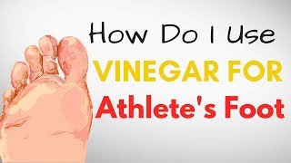 How Do I Use VINEGAR for Athletes Foot Treatment – 9 BEST Remedies [upl. by Bonacci890]