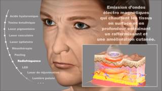 Amélioration cutané par radiofréquence Rajeunissement du visage Dermatologue Montpellier [upl. by Starobin]