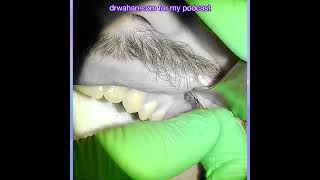 Black  White IMF Screw Removal after Closed Reduction of a Jaw Fracture [upl. by Debi]