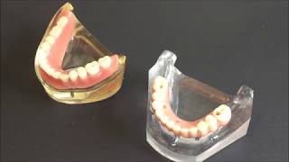 Implant supported denture vs implant retained denture  Bauer Smiles [upl. by Ailed]