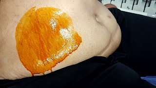 The color and shape of 18 liters of abdominal fluid ascites in the patient with liver cancer [upl. by Gifferd763]