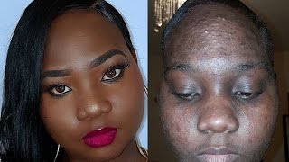 HOW TO ACNE COVERAGE FOUNDATION ROUTINE SKIN CARE REGIME ACNE JOURNEY [upl. by Euqinot]