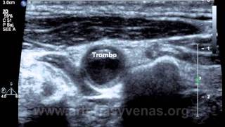 Trombosis carotídeo vertebral carotid vertebral thrombosis [upl. by Yecnuahc295]