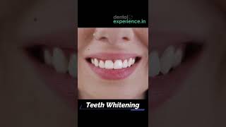 Tooth Cleaning  Teeth Scaling I stain or Tartar Removal cost  Dentalexperiencein [upl. by Schou365]