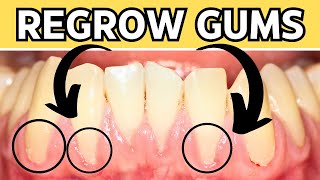 How To REGROW Receding Gums Naturally At Home [upl. by Eruot]