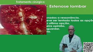 Dr Renato Bastos  Espondilose lombar [upl. by Aidroc823]