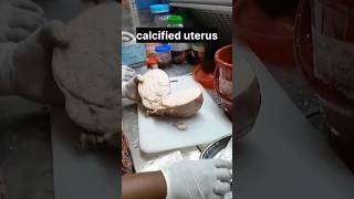 calcified uterus  histopathology [upl. by Ahseeyt265]