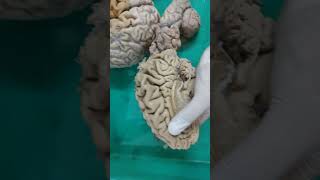 gyrus and sulcus of brain🧠MBBS 1ST YEAR ANATOMY DISSECTION⚕️ neet mbbs youtube doctor subscribe [upl. by Hairaza791]