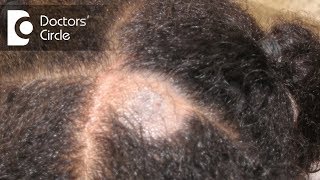 What causes Scalp Ringworm Effective Treatment   Tinea Capitis  Dr Tina Ramachander [upl. by Llerraj447]