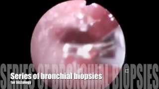 bronchial biopsy [upl. by Lourdes]