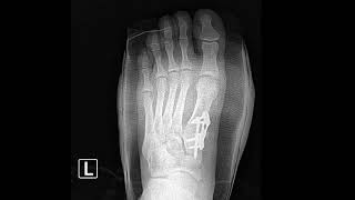 Lapidus Procedure to Correct a bunion Foot Deformity [upl. by Teufert]