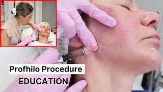 Profhilo Procedure and Correct Injection Technique 2024 [upl. by Rednav]