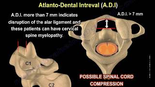 Rheumatoid Arthritis of the cervical spine  Everything You Need To Know  Dr Nabil Ebraheim [upl. by Ykroc]