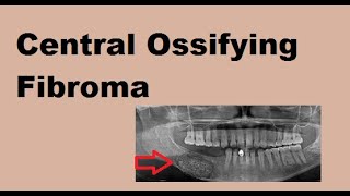 Central Ossifying Fibroma [upl. by Nagar]