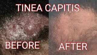 TINEA CAPITIS UPDATE [upl. by Alliscirp283]