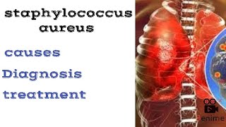 staphylococcus aureus pneumonia  Diagnosis of staphylococcus pneumoniae  treatment of spneumonia [upl. by Aneelad]