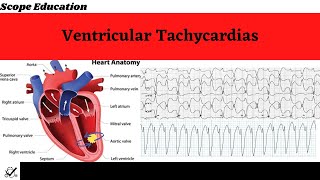 Identifying the Different Types of Ventricular Tachycardias [upl. by Aribold720]