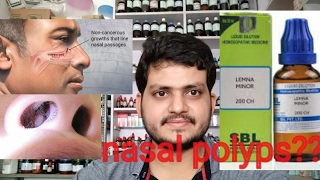 Nasal polypsHomeopathic medicine for nasal polyps explain [upl. by Davey766]