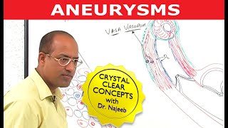 Aneurysms  Causes and Symptoms  Cardiology [upl. by Pompea]