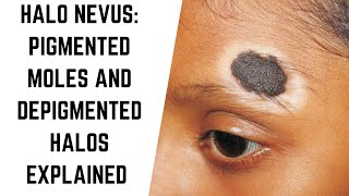 Understanding Halo Nevus Pigmented Moles and Depigmented Halos Explained skintreatment [upl. by Einnahpets]