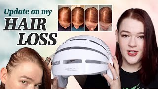 My Hair Loss Experience Update  Rogaine and CurrentBody Skin LED Hair Regrowth Device Review [upl. by Marianne]