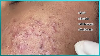 Big Cystic Acne Blackheads Extraction Blackheads amp Milia Whiteheads Removal Pimple Popping [upl. by Criswell]