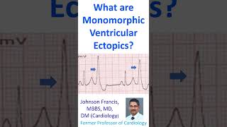 What are monomorphic ventricular ectopics [upl. by Shawna253]