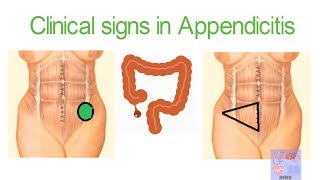 AppendicitisClinical examinations Medical signsMBS [upl. by Mir]