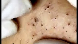 Amazing Blackheads just wait for it [upl. by Strohbehn]