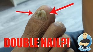 TRIMMING OF A DAMAGED THICKENED SPLIT TOENAIL WITHOUT REMOVAL [upl. by Ward]