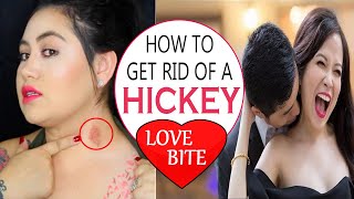 How to Get Rid of a Hickey Fast  Home Remedies for Love Bite Removal  Remove Hickey Fast [upl. by Euqinot]