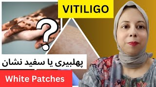 سکن پہ سفید داغ اور پھلبیری میں فرق White Patches And Vitiligo Treatment [upl. by Artinak]