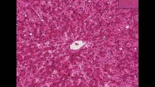 Histopathology Liver Amyloidosis [upl. by Nirok660]