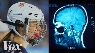 Why women’s ice hockey has a higher concussion rate than football [upl. by Langer]