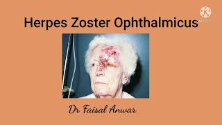 Herpes Zoster Ophthalmicus II Hutchinsons sign II Postherpetic Neuralgia [upl. by Yeliak782]