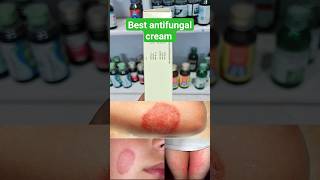 KT5 Derm Cream  KT5 Derm cream use in hindi shorts cream [upl. by Noiramaj]