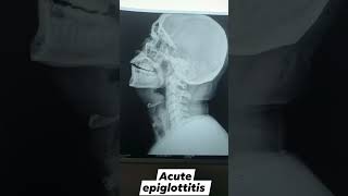 acute epiglottitis  thumb sign on xray laryngoscopy IDL fodl [upl. by Marjie]