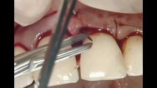 Tratamiento Periodontal Con Straumann Emdogain [upl. by Sargent405]