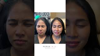 Xeomin Results for Crows Feet 11 Lines and Forehead  Dr Kami Parsa [upl. by Eiramadnil]