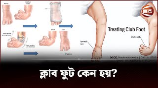 ক্লাব ফুট কেন হয়  Clubfoot  clubfoot treatment  Channel 24 [upl. by Elawalo]