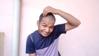 Minoxidil Review After Use 9 Month। Sonu Kumar Mishra। [upl. by Eisle]