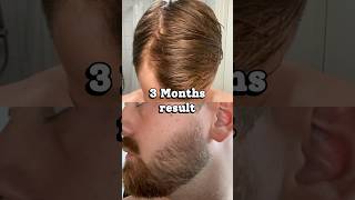 This is what derma rolling and minoxidil did to my hair and beard in 3 months [upl. by Eniamirt]