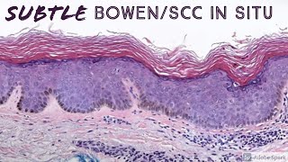 Subtle squamous cell carcinoma in situ Bowen disease  Large cell acanthoma [upl. by Ybroc]