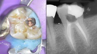 LIVE Molar Root Canal w Hyperemic Pulp  Distal Caries Molar Access FULL LENGTH [upl. by Sema]