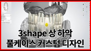 3shape full arch design custom abutment 상하악 풀아치 커스텀 디자인 [upl. by Elke]