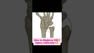 DRUJ injury neet mbbs trending shorts ortho [upl. by Eittocs]