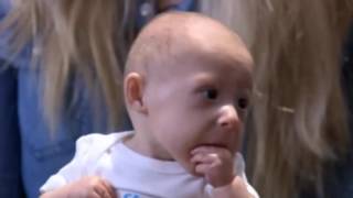 Matthew Kentucky baby born with rare form of dwarfism type II MOPD II [upl. by Kubiak340]